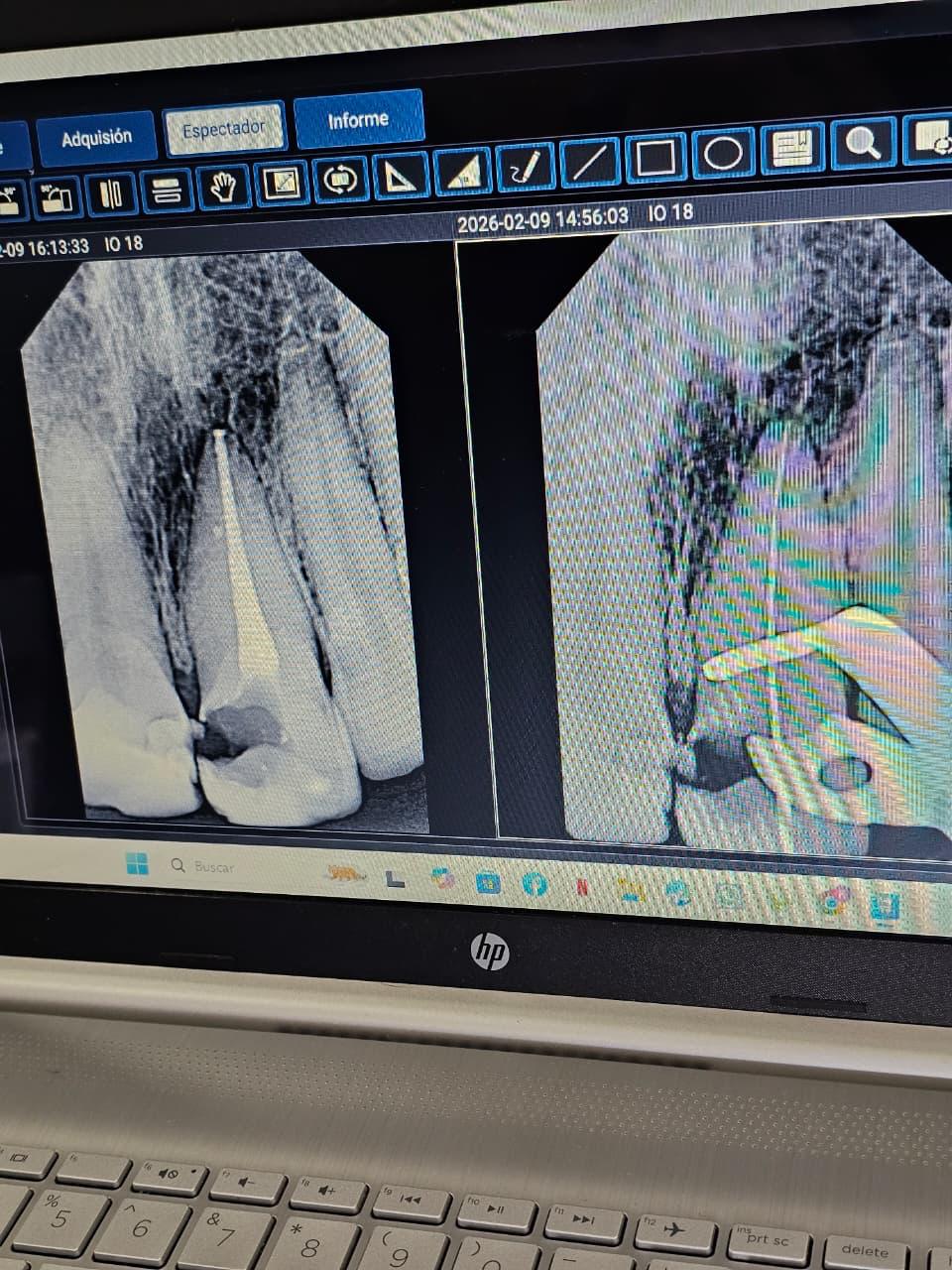 Endodoncia