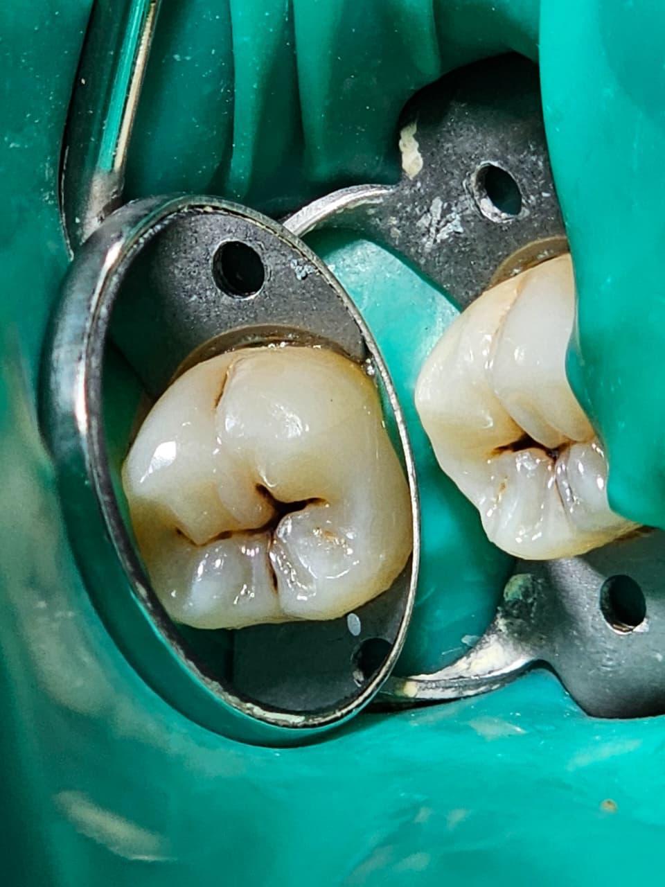 Endodoncia