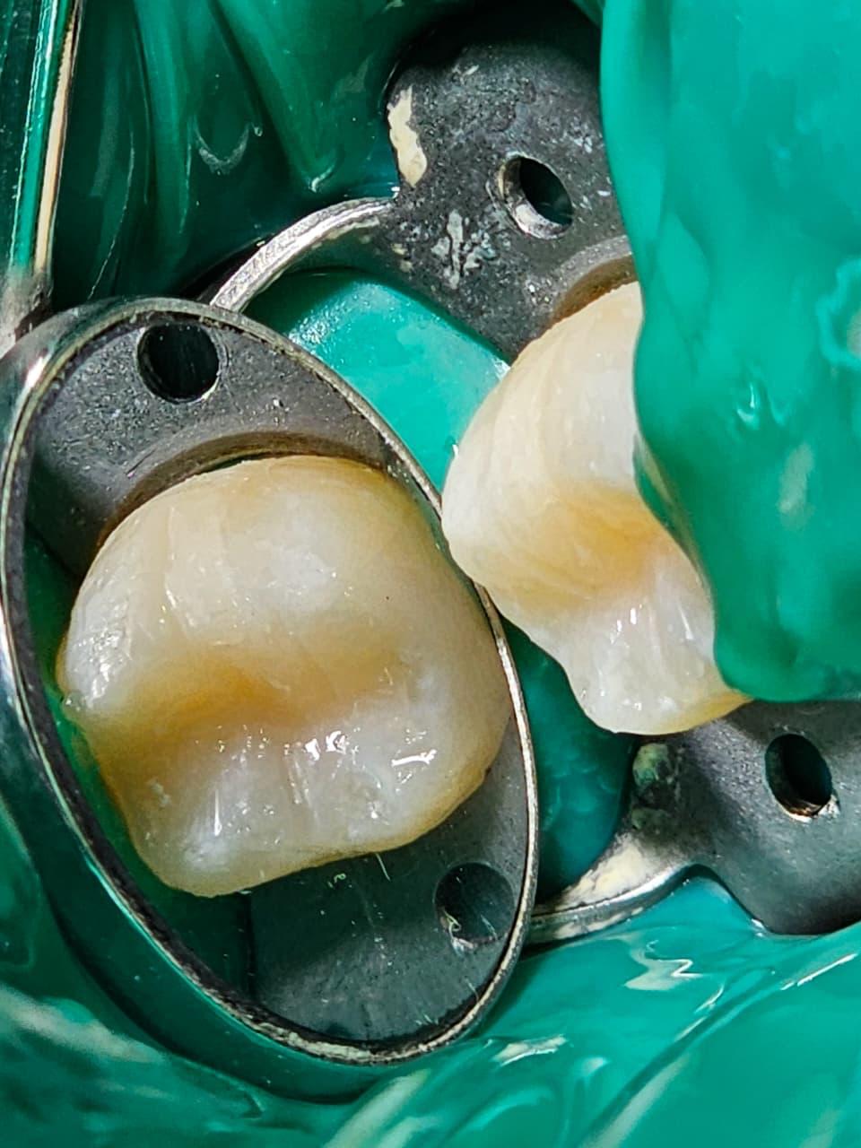 Endodoncia